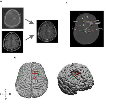 Quantification of Epileptogenic Network From Stereo EEG Recordings Using Epileptogenicity Ranking Method